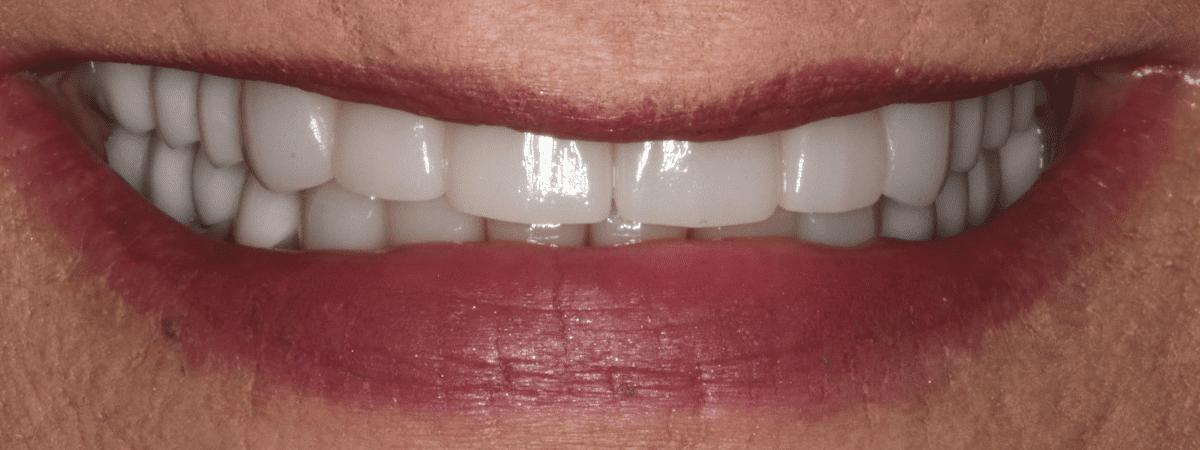 dental implants Bethlehem GA