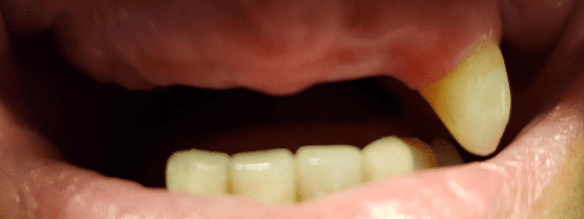 before dentures